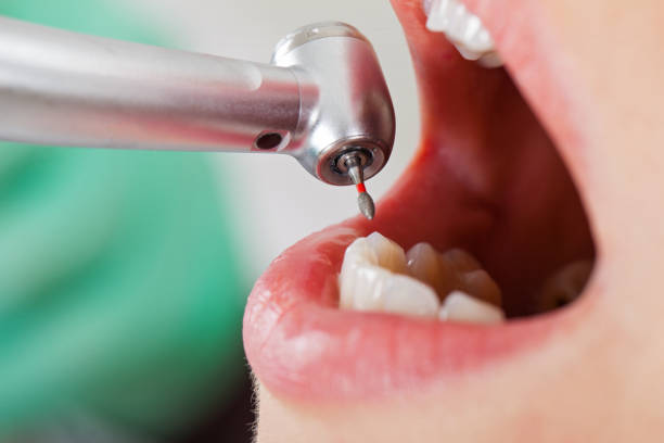 Best Lost Filling or Crown Replacement in Selmer, TN